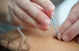 Graviditets Relateret Akupunktur